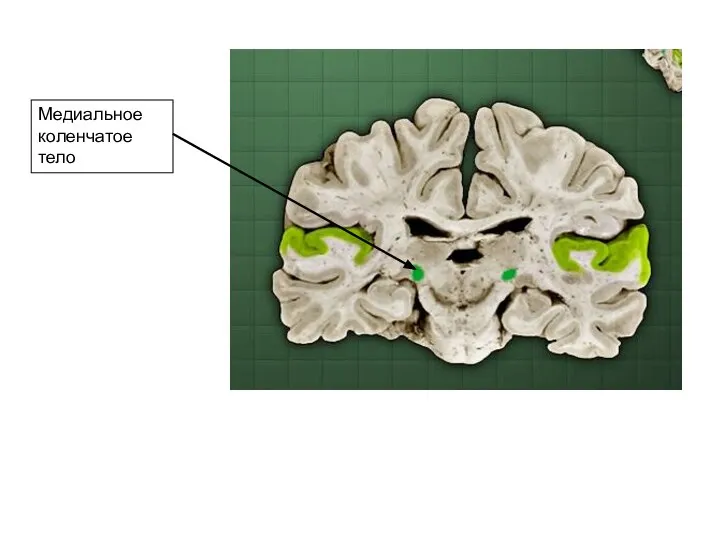 Медиальное коленчатое тело