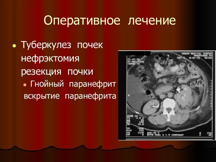 Оперативное лечение Туберкулез почек нефрэктомия резекция почки Гнойный паранефрит вскрытие паранефрита