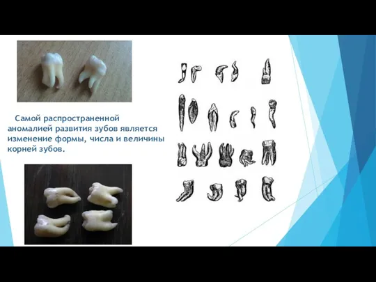 Самой распространенной аномалией развития зубов является изменение формы, числа и величины корней зубов.