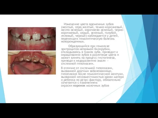 Изменение цвета временных зубов (желтый, серо-желтый, темно-коричневый, желто-зеленый, коричнево-зеленый, черно-коричневый, серый, зеленый,
