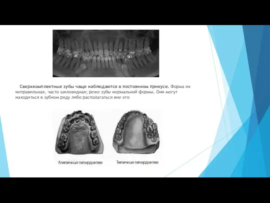 Сверхкомплектные зубы чаще наблюдаются в постоянном прикусе. Форма их неправильная, часто шиловидная;