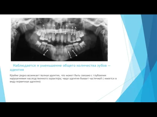 Наблюдается и уменьшение общего количества зубов — адентия Крайне редко возникает полная