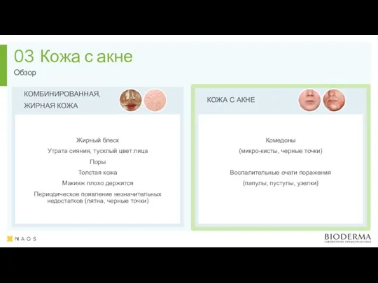 Кожа с акне 03 КОМБИНИРОВАННАЯ, ЖИРНАЯ КОЖА Жирный блеск Утрата сияния, тусклый