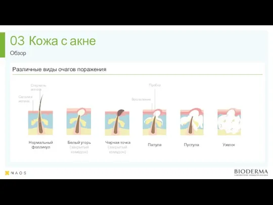 Кожа с акне Обзор 03 Белый угорь (закрытый комедон) Нормальный фолликул Черная