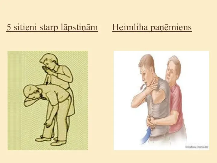 5 sitieni starp lāpstiņām Heimliha paņēmiens