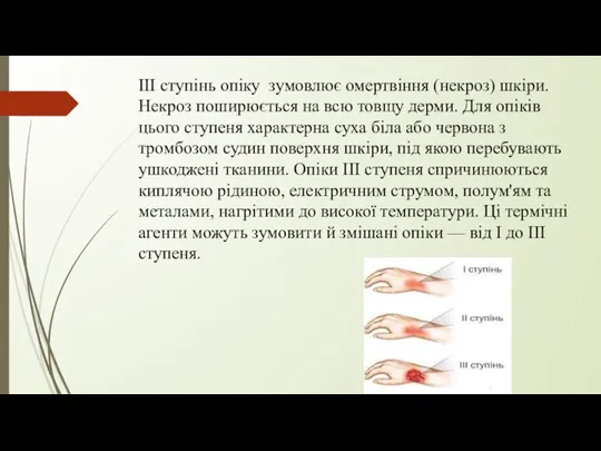 III ступінь опіку зумовлює омертвіння (некроз) шкіри. Некроз поширюється на всю товщу