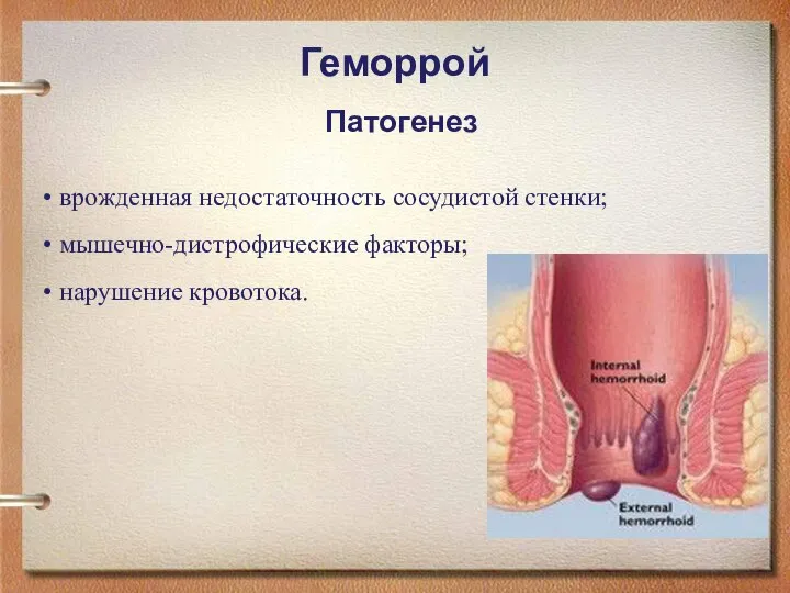 Геморрой Патогенез врожденная недостаточность сосудистой стенки; мышечно-дистрофические факторы; нарушение кровотока.