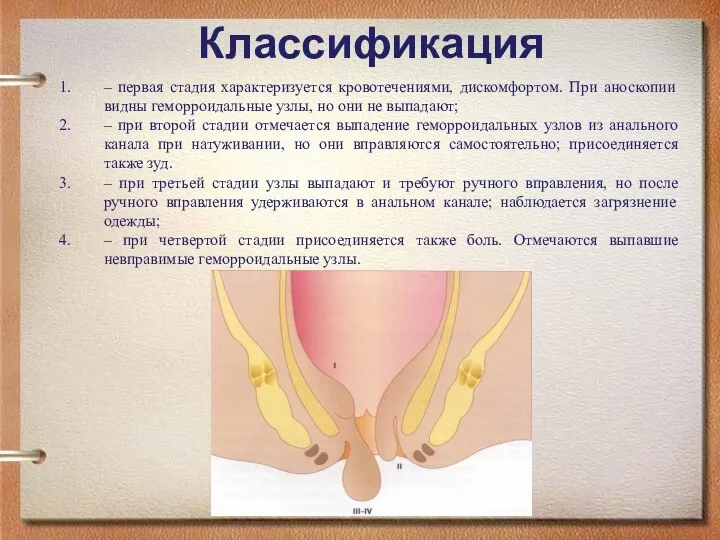 Классификация – первая стадия характеризуется кровотечениями, дискомфортом. При аноскопии видны геморроидальные узлы,