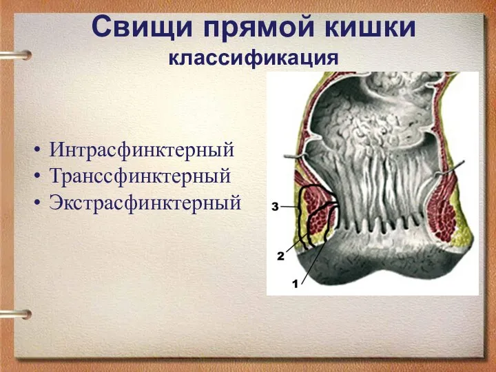 Свищи прямой кишки классификация Интрасфинктерный Транссфинктерный Экстрасфинктерный