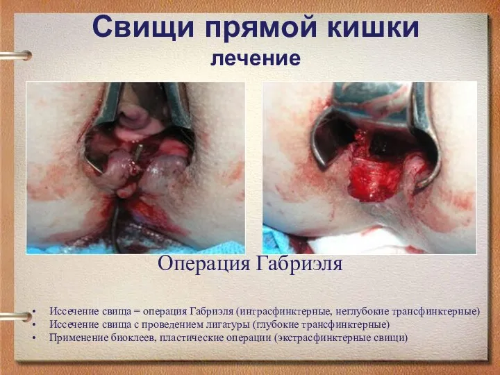 Свищи прямой кишки лечение Иссечение свища = операция Габриэля (интрасфинктерные, неглубокие трансфинктерные)