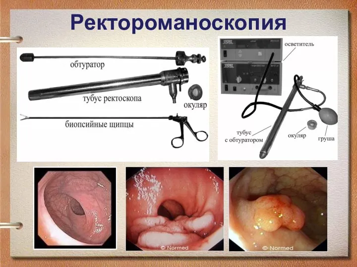 Ректороманоскопия