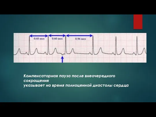 Компенсаторная пауза после внеочередного сокращения указывает на время полноценной диастолы сердца