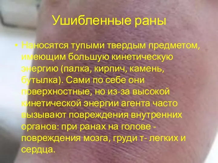 Ушибленные раны Наносятся тупыми твердым предметом, имеющим большую кинетическую энергию (палка, кирпич,