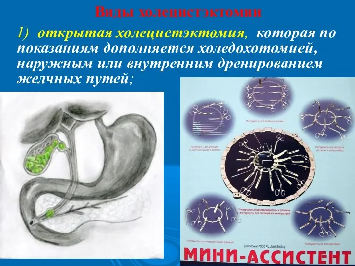 Виды холецистэктомии 1) открытая холецистэктомия, которая по показаниям дополняется холедохотомией, наружным или внутренним дренированием желчных путей;