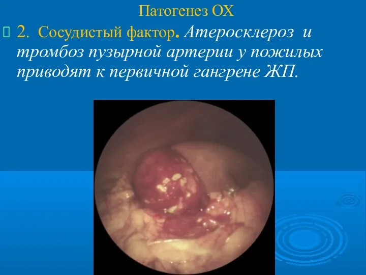 Патогенез ОХ 2. Сосудистый фактор. Атеросклероз и тромбоз пузырной артерии у пожилых