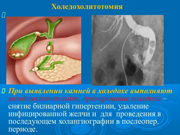 Холедохолитотомия При выявлении камней в холедохе выполняют холедохолитотомию, дренирование холедоха – снятие