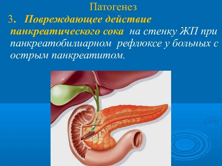 Патогенез 3. Повреждающее действие панкреатического сока на стенку ЖП при панкреатобилиарном рефлюксе
