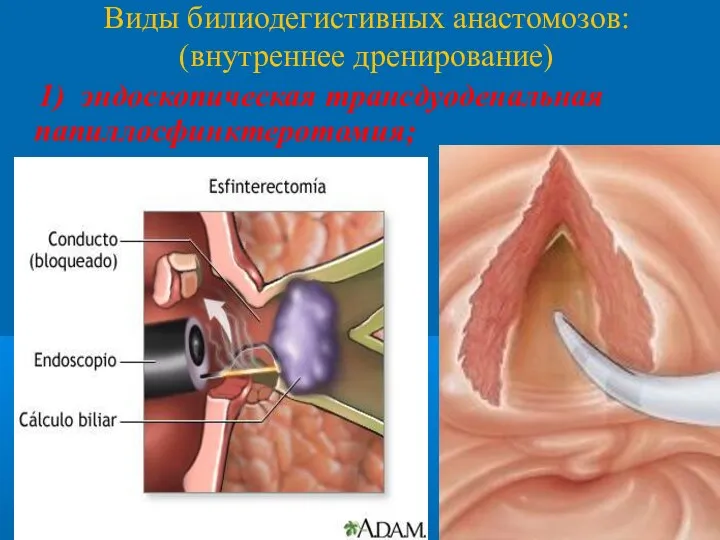 Виды билиодегистивных анастомозов: (внутреннее дренирование) 1) эндоскопическая трансдуоденальная папиллосфинктеротомия;