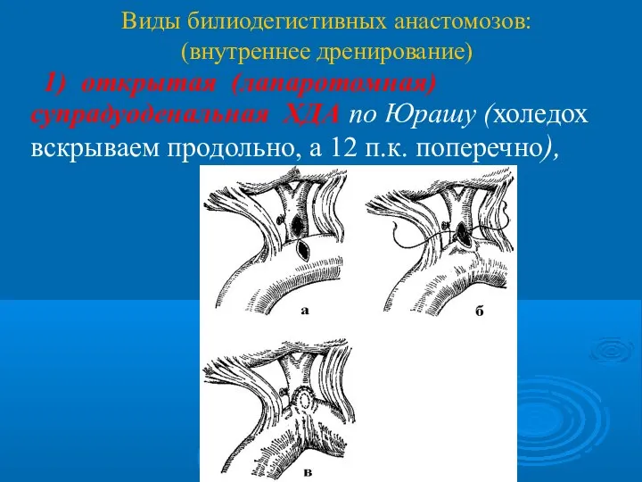 Виды билиодегистивных анастомозов: (внутреннее дренирование) 1) открытая (лапаротомная) супрадуоденальная ХДА по Юрашу
