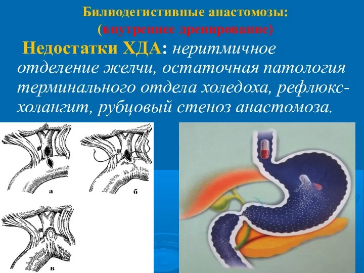 Билиодегистивные анастомозы: (внутреннее дренирование) Недостатки ХДА: неритмичное отделение желчи, остаточная патология терминального