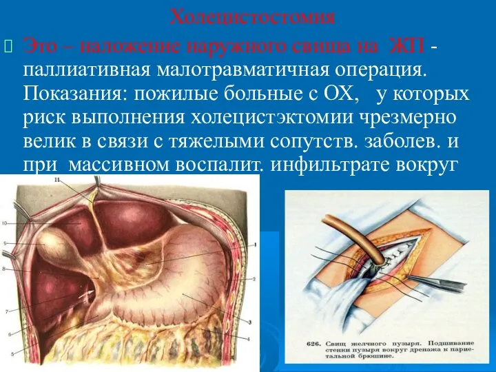 Холецистостомия Это – наложение наружного свища на ЖП - паллиативная малотравматичная операция.