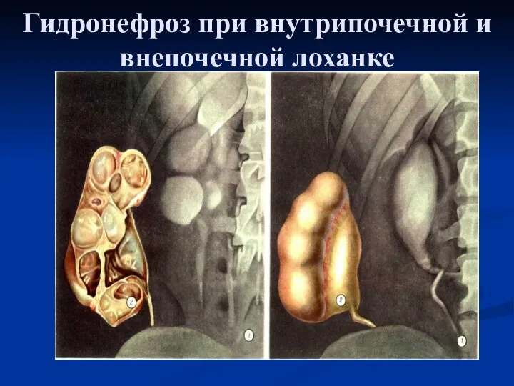 Гидронефроз при внутрипочечной и внепочечной лоханке