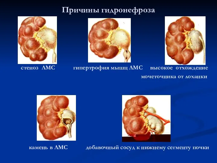 Причины гидронефроза стеноз ЛМС гипертрофия мышц ЛМС высокое отхождение мочеточника от лоханки