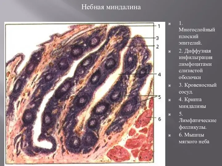 Небная миндалина 1. Многослойный плоский эпителий. 2. Диффузная инфильтрация лимфоцитами слизистой оболочки