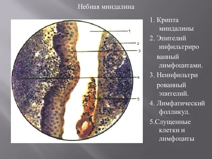 1. Крипта миндалины 2. Эпителий инфильтриро ванный лимфоцитами. 3. Неинфильтри рованный эпителий.