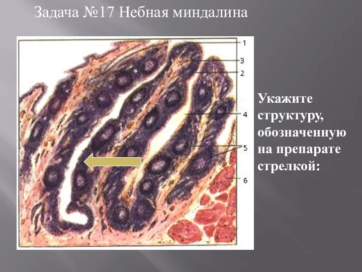 Задача №17 Небная миндалина Укажите структуру, обозначенную на препарате стрелкой: