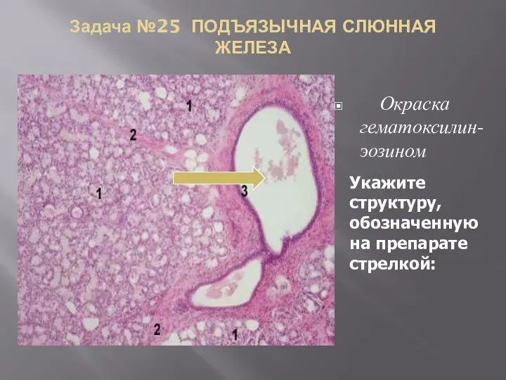 Задача №25 ПОДЪЯЗЫЧНАЯ СЛЮННАЯ ЖЕЛЕЗА Окраска гематоксилин-эозином Укажите структуру, обозначенную на препарате стрелкой: