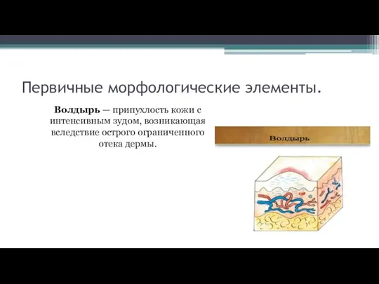 Первичные морфологические элементы. Волдырь — припухлость кожи с интенсивным зудом, возникающая вследствие острого ограниченного отека дермы.