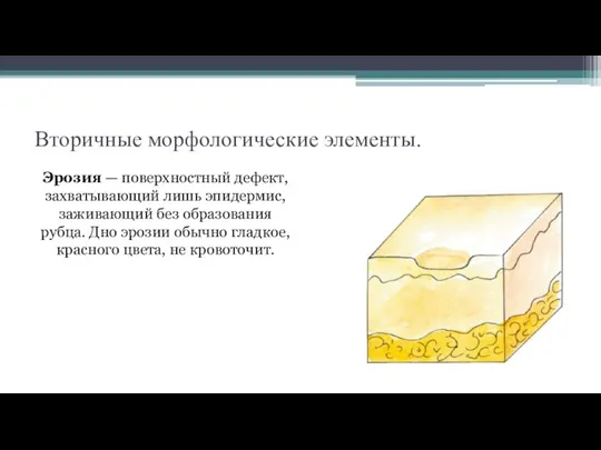 Вторичные морфологические элементы. Эрозия — поверхностный дефект, захватывающий лишь эпидермис, заживающий без