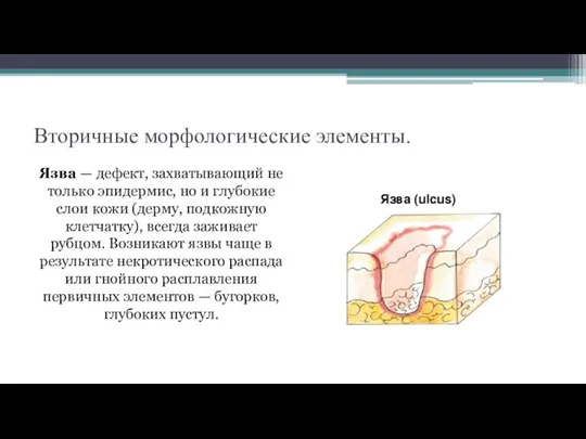 Вторичные морфологические элементы. Язва — дефект, захватывающий не только эпидермис, но и