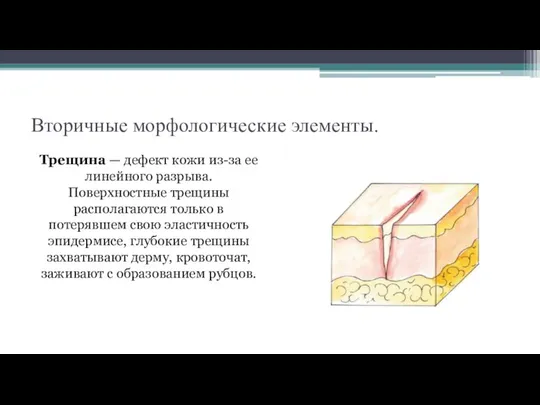 Вторичные морфологические элементы. Трещина — дефект кожи из-за ее линейного разрыва. Поверхностные