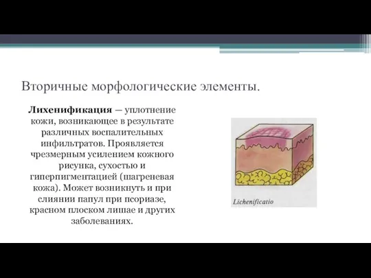 Вторичные морфологические элементы. Лихенификация — уплотнение кожи, возникающее в результате различных воспалительных