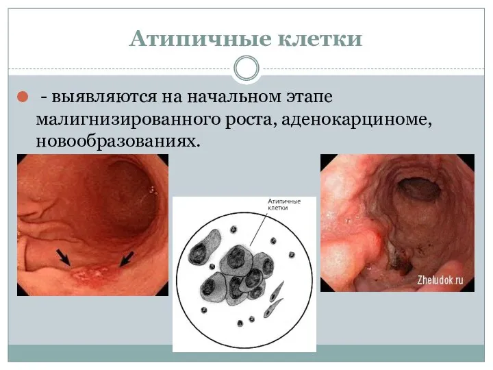 Атипичные клетки - выявляются на начальном этапе малигнизированного роста, аденокарциноме, новообразованиях.