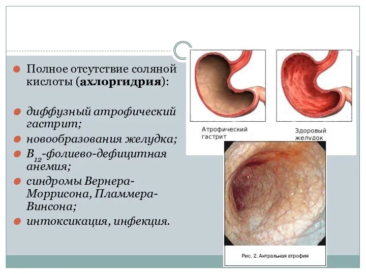 Полное отсутствие соляной кислоты (ахлоргидрия): диффузный атрофический гастрит; новообразования желудка; B12-фолиево-дефицитная анемия;