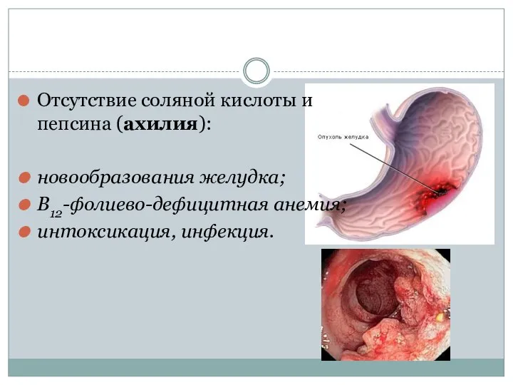 Отсутствие соляной кислоты и пепсина (ахилия): новообразования желудка; B12-фолиево-дефицитная анемия; интоксикация, инфекция.