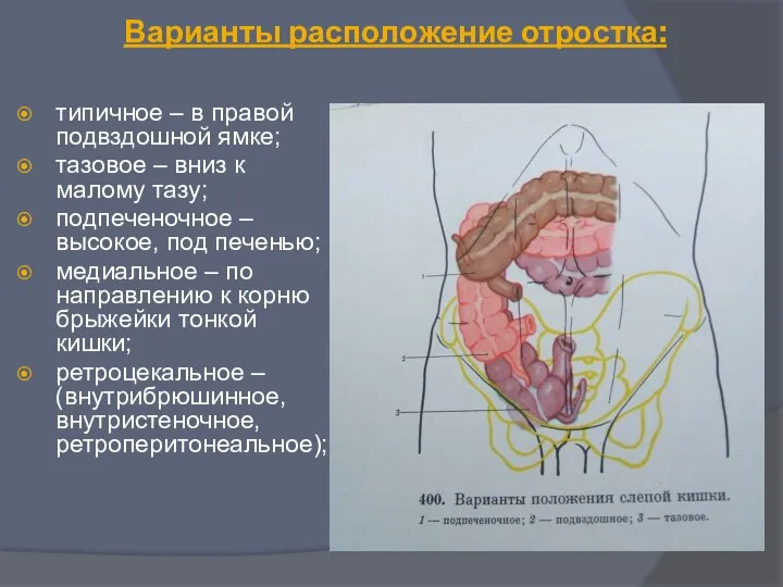 Варианты расположение отростка: типичное – в правой подвздошной ямке; тазовое – вниз