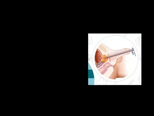 Эндоскопическая уретротомия Это операция рассечения стриктуры уретры при помощи эндоскопа. Показание :наличие