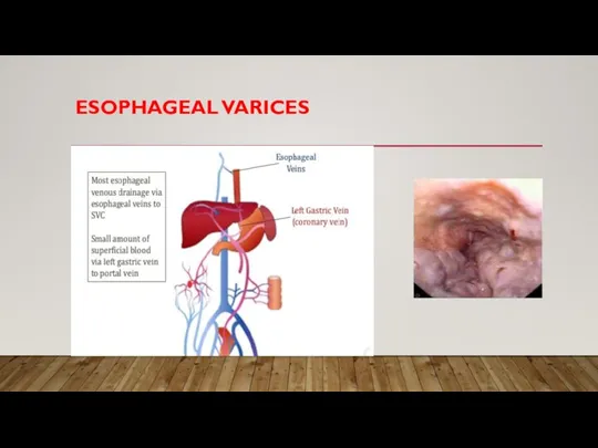 ESOPHAGEAL VARICES