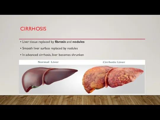 CIRRHOSIS • Liver tissue replaced by fibrosis and nodules • Smooth liver