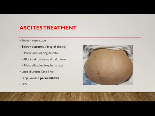 ASCITES TREATMENT • Sodium restriction • Spironolactone (drug of choice) • Potassium-sparing