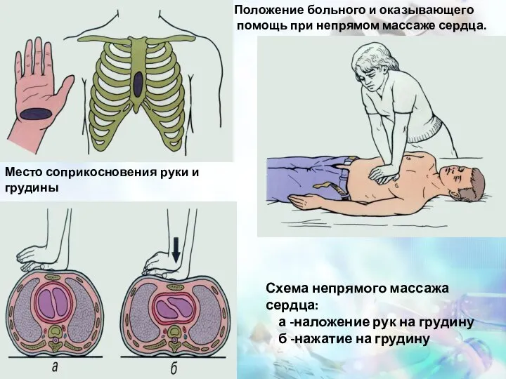 Место соприкосновения руки и грудины Положение больного и оказывающего помощь при непрямом