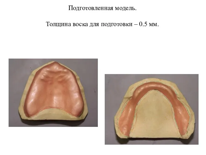 Подготовленная модель. Толщина воска для подготовки – 0.5 мм.