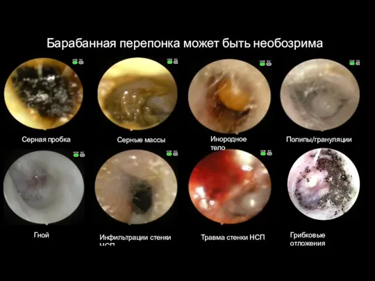 Барабанная перепонка может быть необозрима Серная пробка Серные массы Инородное тело Гной