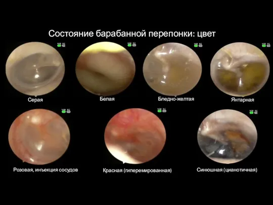 Состояние барабанной перепонки: цвет Серая Белая Бледно-желтая Янтарная Розовая, инъекция сосудов Красная (гиперемированная) Синюшная (цианотичная)