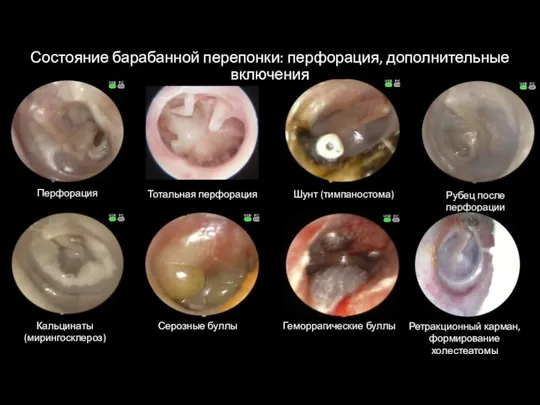 Состояние барабанной перепонки: перфорация, дополнительные включения Перфорация Тотальная перфорация Шунт (тимпаностома) Рубец