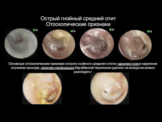 Острый гнойный средний отит Отоскопические признаки Основные отоскопические признаки острого гнойного среднего